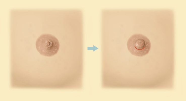 Before After Nipple Surgery