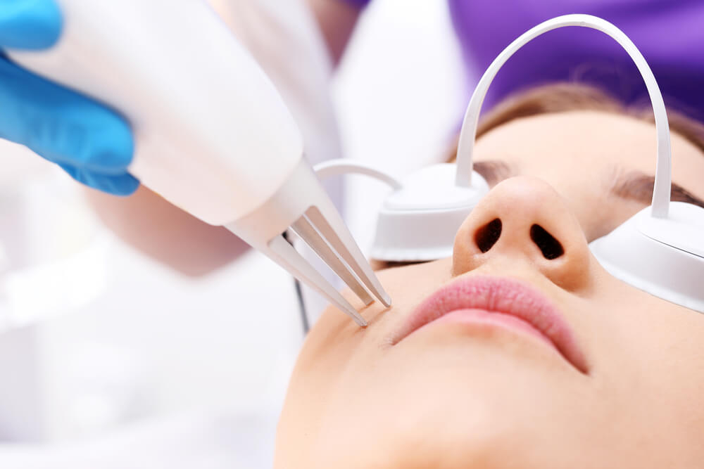 Everything You Should Know About Acne Scar Laser Treatment