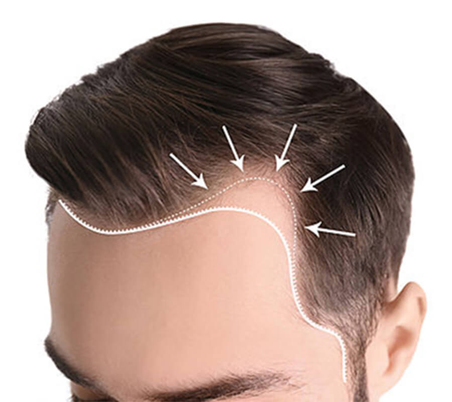 Hair Transplantation 3