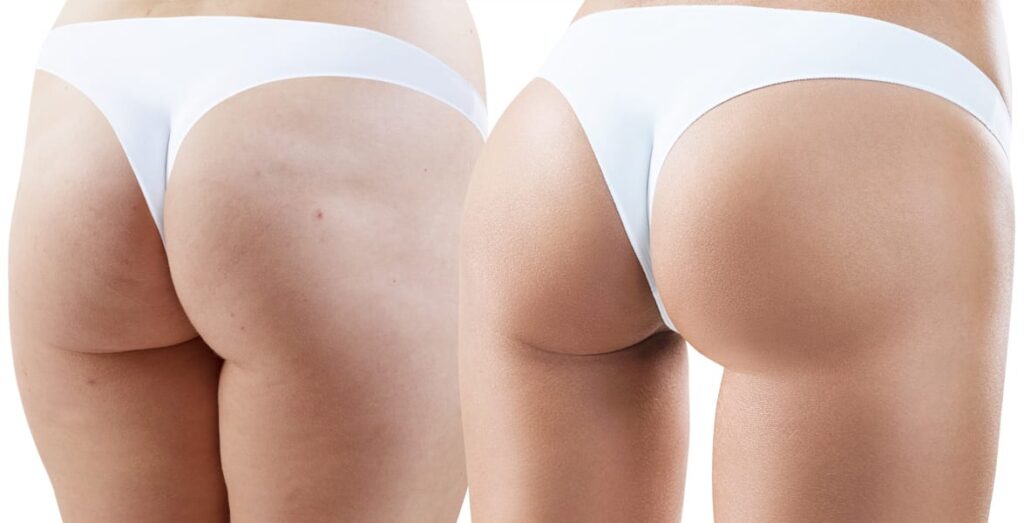 Nonsurgical Butt Lift 3