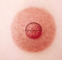 nipple reconstruction 6