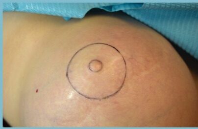 nipple reconstruction