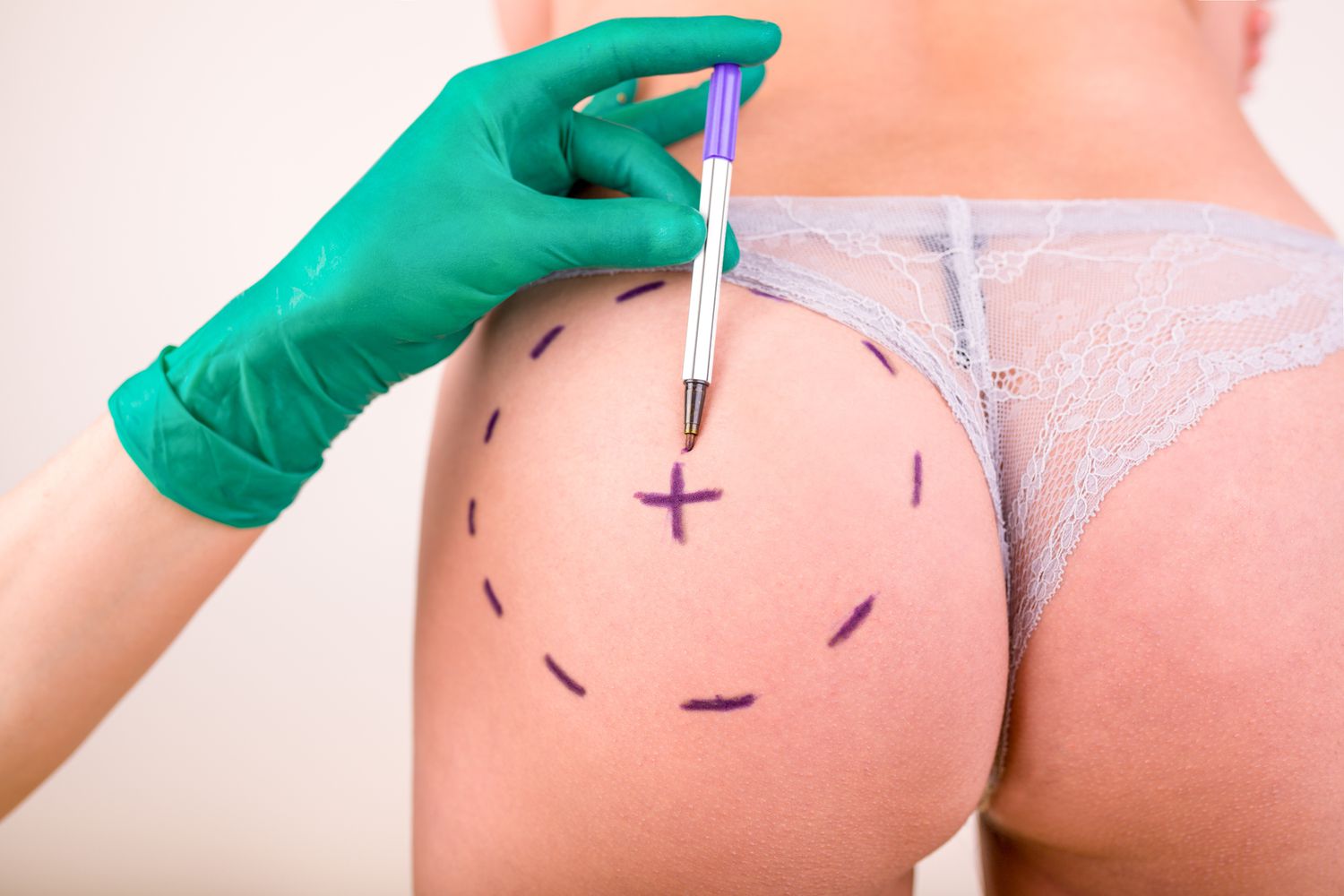 Nonsurgical Butt Lift